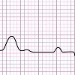 دانلود رایگان پاورپوینت آشنایی با اصول و تفسیر نوار قلب یا ECG