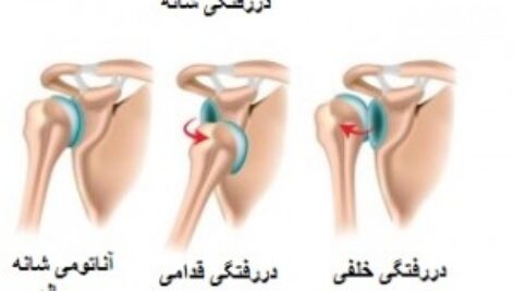 پاورپوینت کامل و جامع با عنوان آشنایی با  دررفتگی و انواع آن در تربیت بدنی در 42 اسلاید