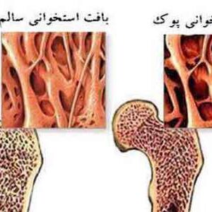 پاورپوینت کامل و جامع با عنوان پوکی استخوان در 48 اسلاید