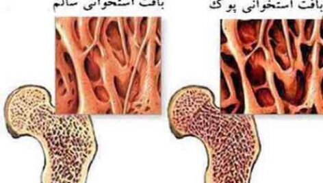 پاورپوینت کامل و جامع با عنوان پوکی استخوان در 48 اسلاید