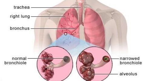 دانلود پاورپوینت بیماری‌های مزمن انسدادی ریه(COPD)