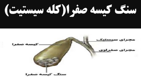 دانلود پاورپوینت بیماری کله سیستیت یا سنگ کیسه صفرا