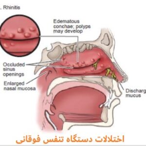 دانلود پاورپوینت در مورد اختلالات دستگاه تنفس فوقانی