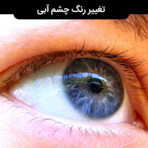 تغییر رنگ چشم به رنگ آبی در 2 الی 4 ماه